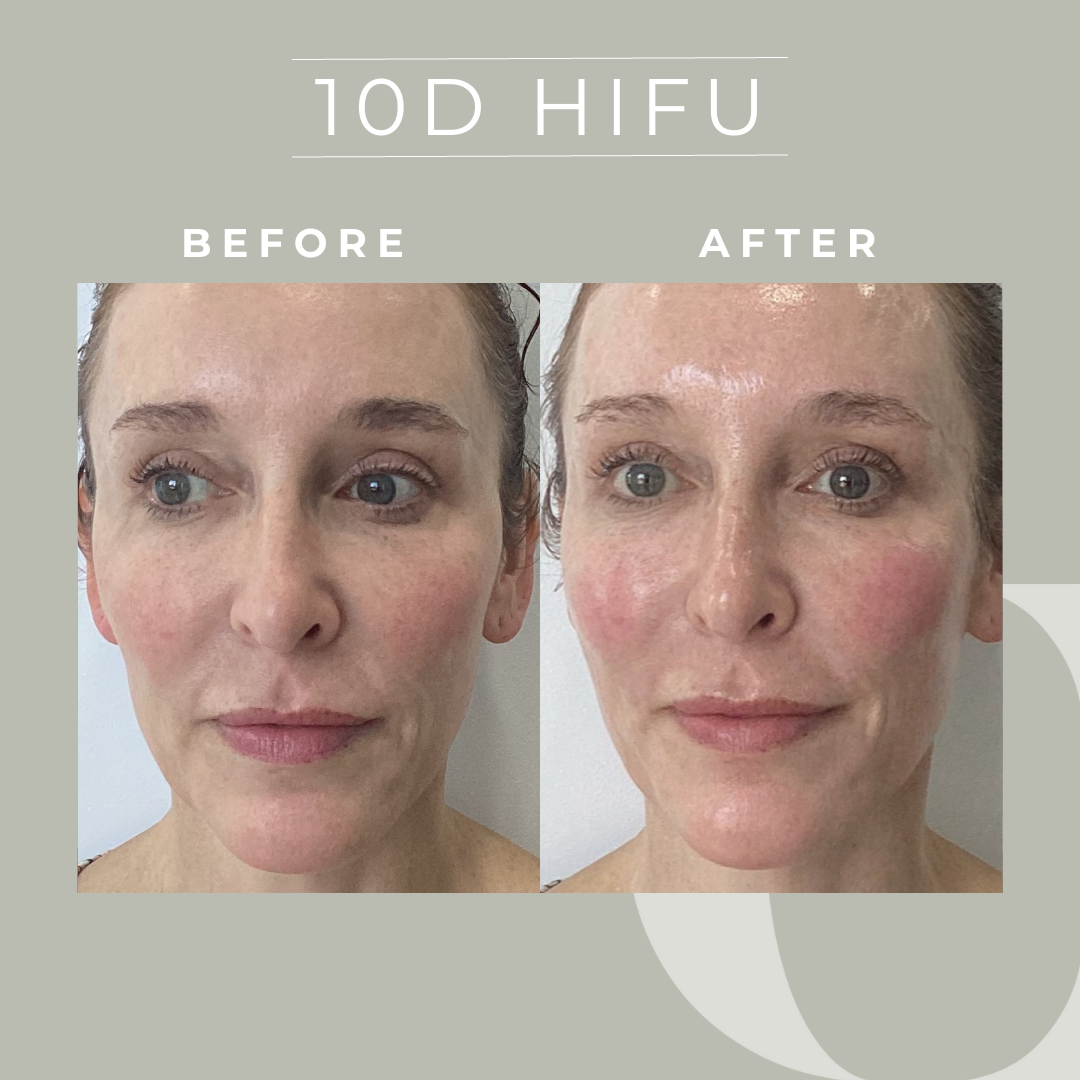 HIFU Before & After, Results